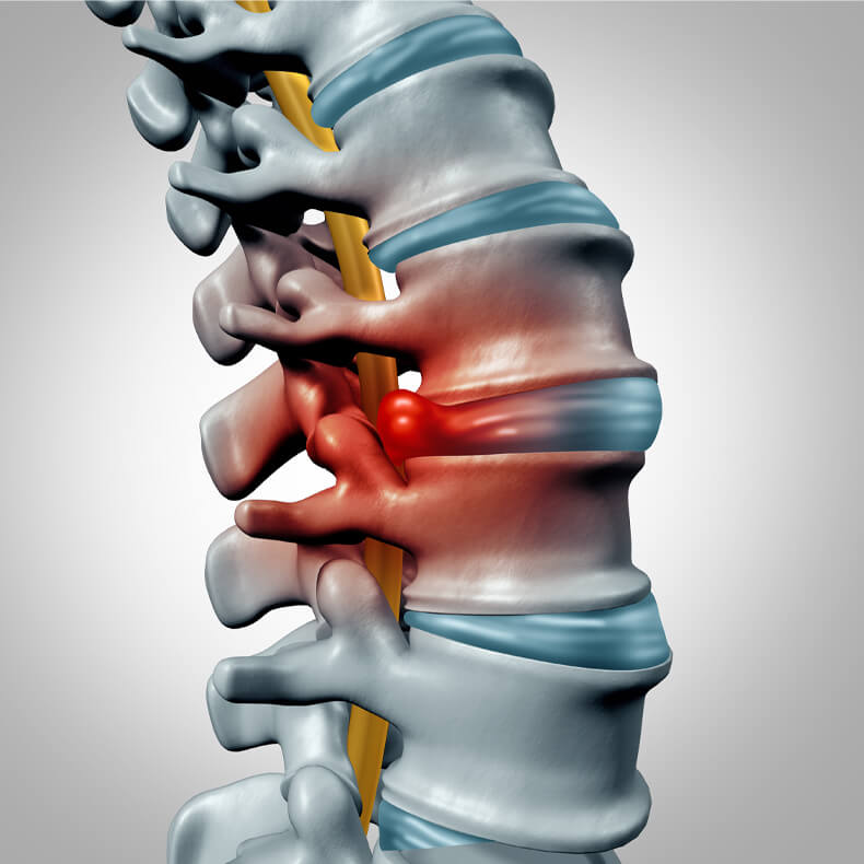 herniated disc in neck